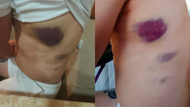 FOTO - Studenti u blokadi objavili fotografiju modrica za koje tvrde da su nastale tokom policijskog zadržavanja nakon Vidovdana